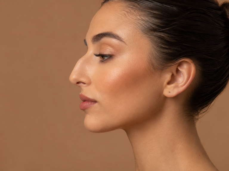 Rinoplastia — resultado antes e depois (Dra. Alessandra Stanquini)