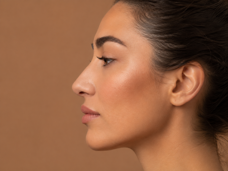 Rinoplastia — resultado antes e depois (Dra. Alessandra Stanquini)