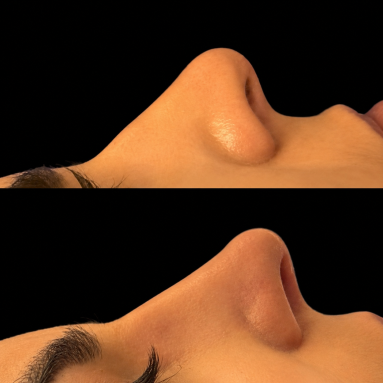 Antes x depois 8